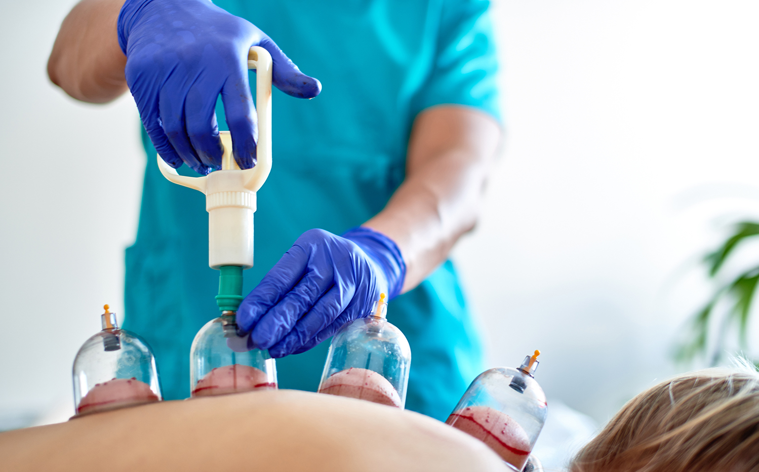 Kupa Tedavisi-Hacamat